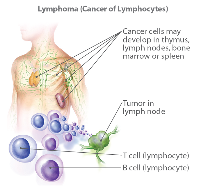 Understanding Lymphoma