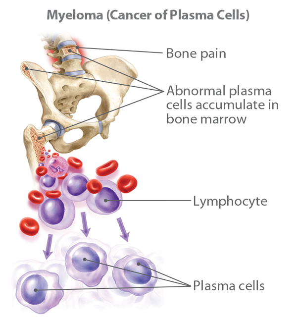 Understanding Myeloma
