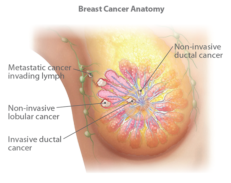 Understanding Breast Cancer
