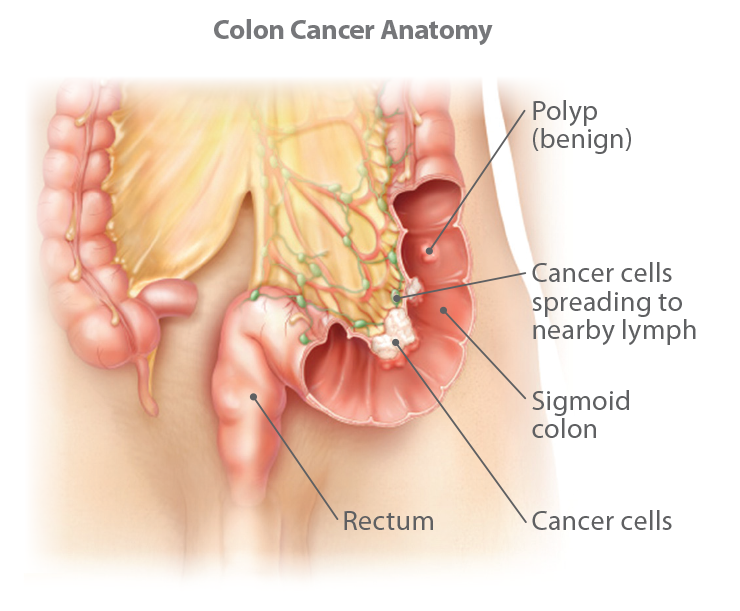 Understanding Colorectal Cancer 2