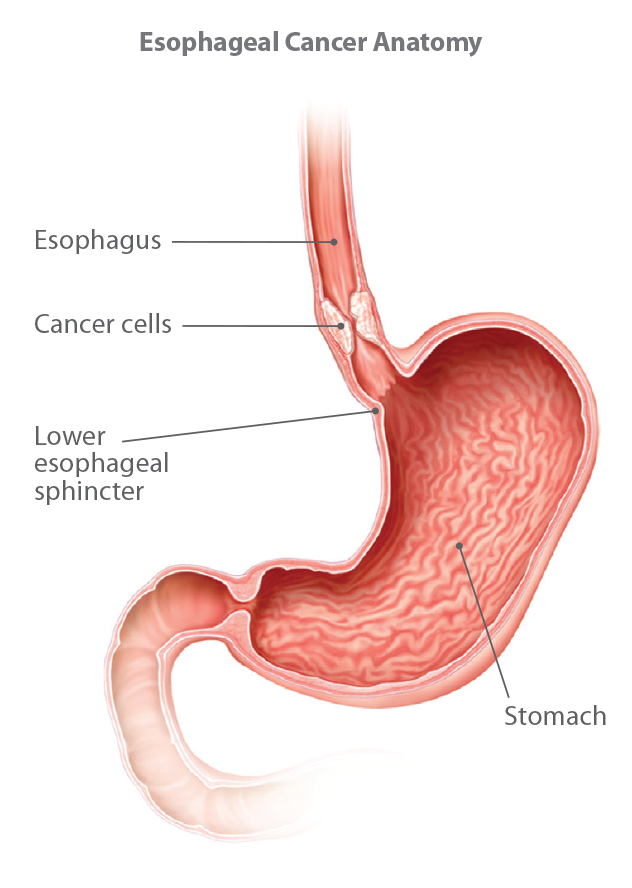 Understanding Esophageal Cancer 2