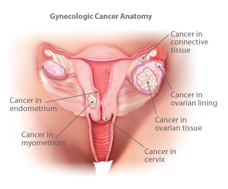 Understanding Gynecologic Cancer 2