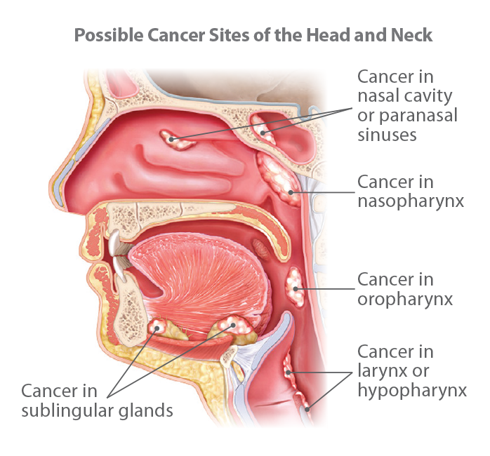 Understanding Head and Neck Cancer 2