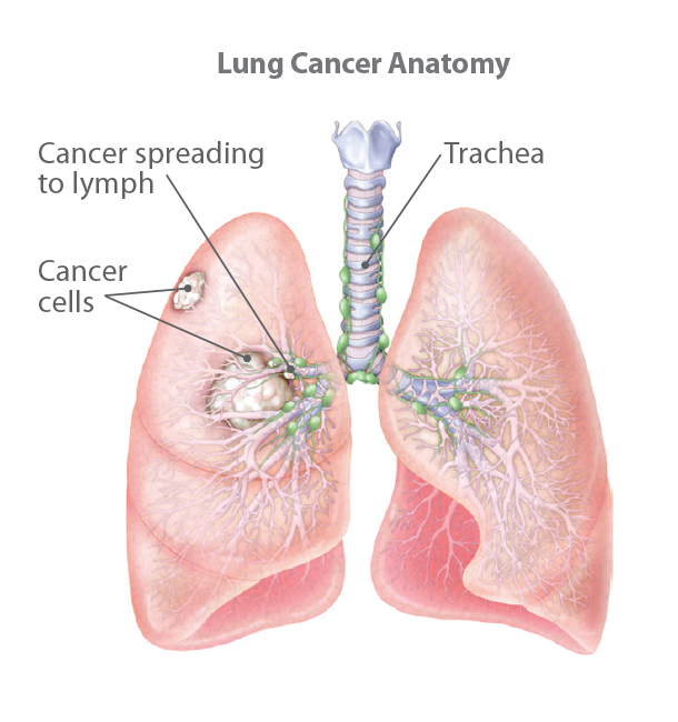 Understanding Lung Cancer 2