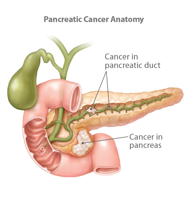 Understanding Pancreatic Cancer 2