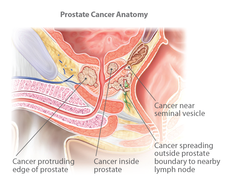 Understanding Prostate Cancer 2