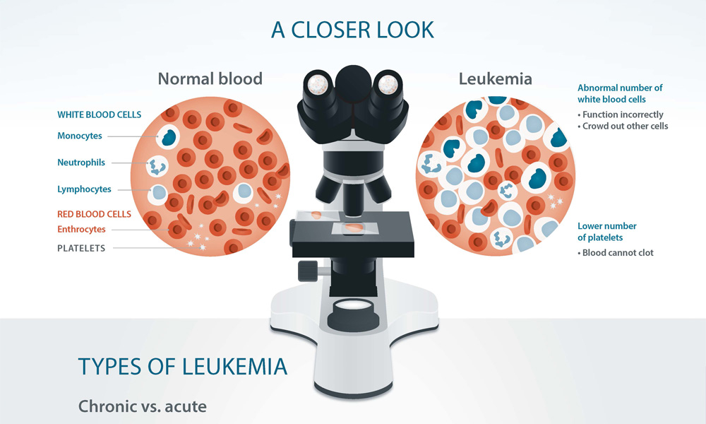 Chronic vs acute leukemia types and primary characteristics