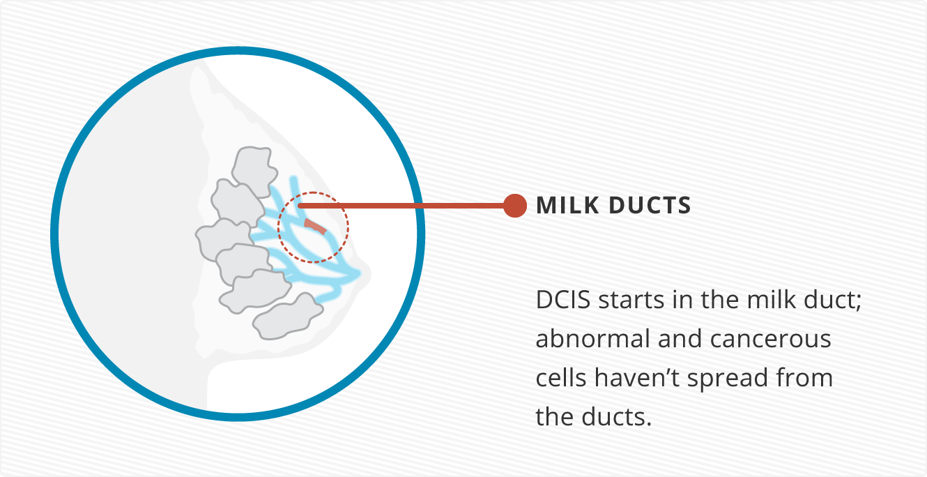 Illustration of a common breast cancer, ductal carcinoma in situ, starting in the milk duct
