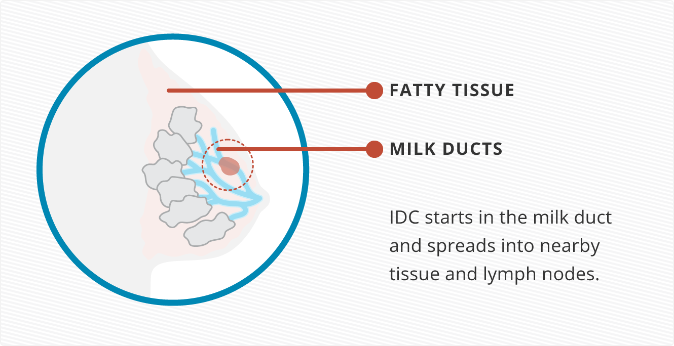 Illustration of the most common breast cancer, invasive ductal carcinoma, starting in the milk duct and spreading in the breast fatty tissue