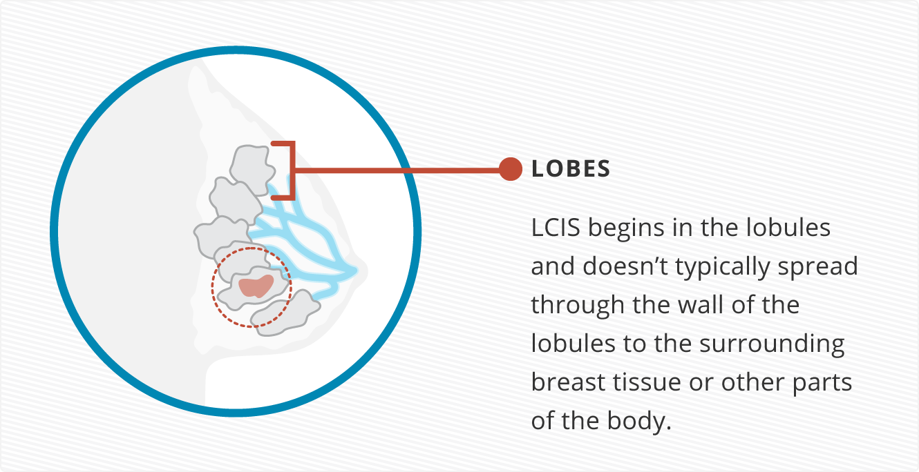 Illustration of LCIS starting in the lobules of the breast