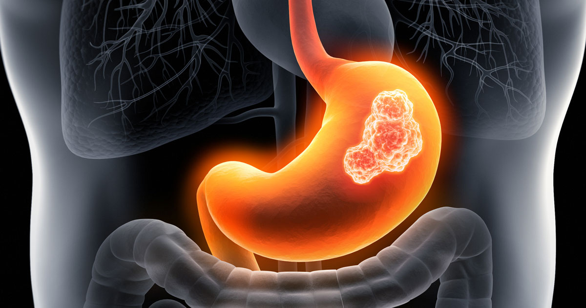 Changing U.S. Incidence of Lower Stomach Cancer - NCI