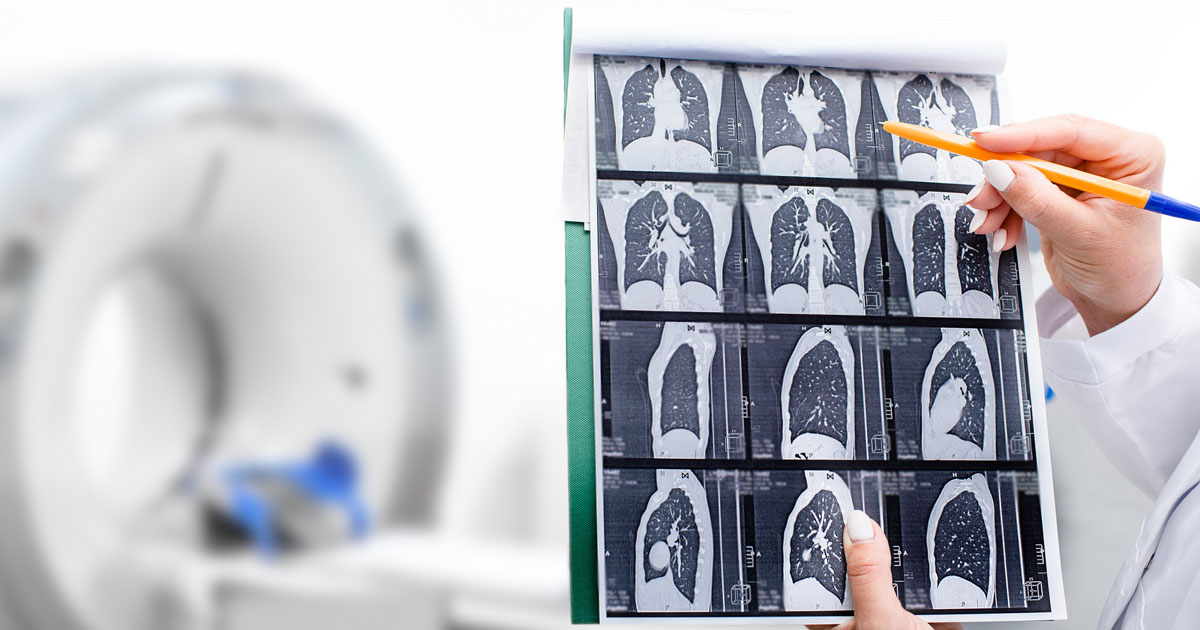 A low-dose ct scan can help detect lung cancer.