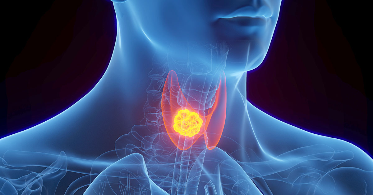 Why thyroid cancer patients may need a low-iodine diet