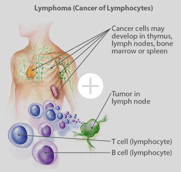 llustration of how lymphoma develops in the lymphocytes