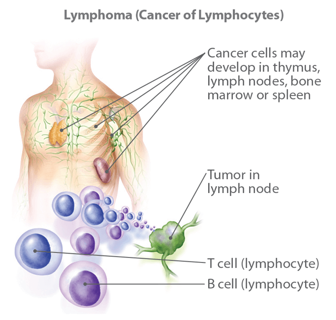 Learn About Non-Hodgkin Lymphoma: Information, Facts & Overview | CTCA